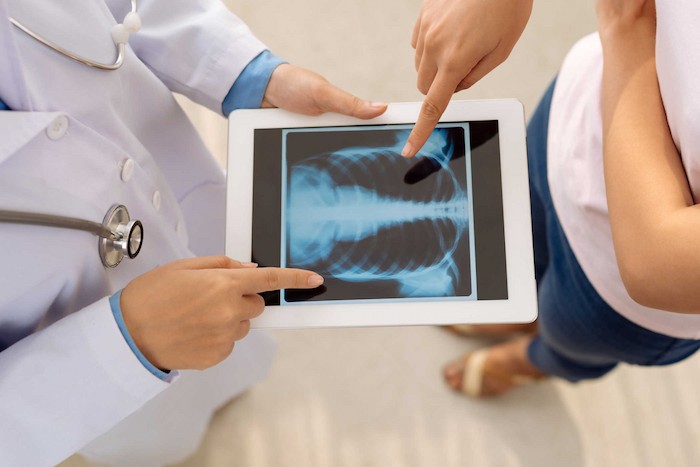 Chụp X-quang có thể tầm soát bệnh lao phổi từ sớm