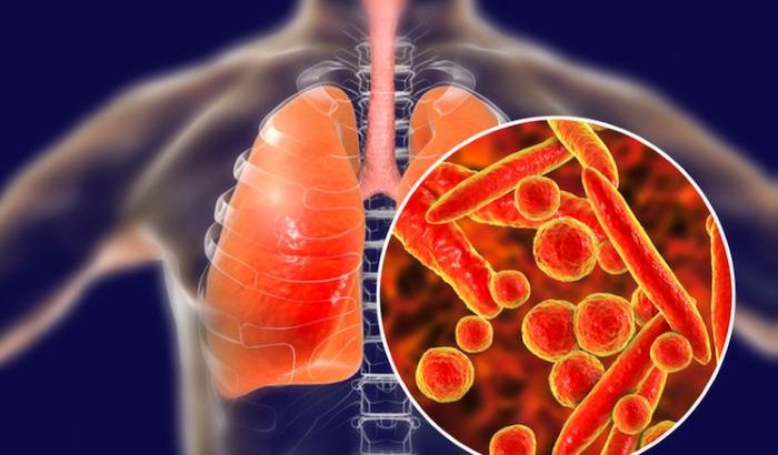 Triệu chứng lao phổi giai đoạn đầu: Cách nhận biết và điều trị