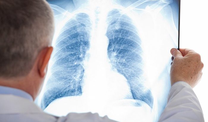 Giải đáp từ chuyên gia: Bệnh lao phổi có quan hệ được không? 