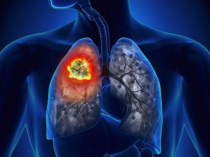 Sử dụng thuốc miễn dịch là một trong những cách chữa ung thư phổi mang lại hiệu quả cao