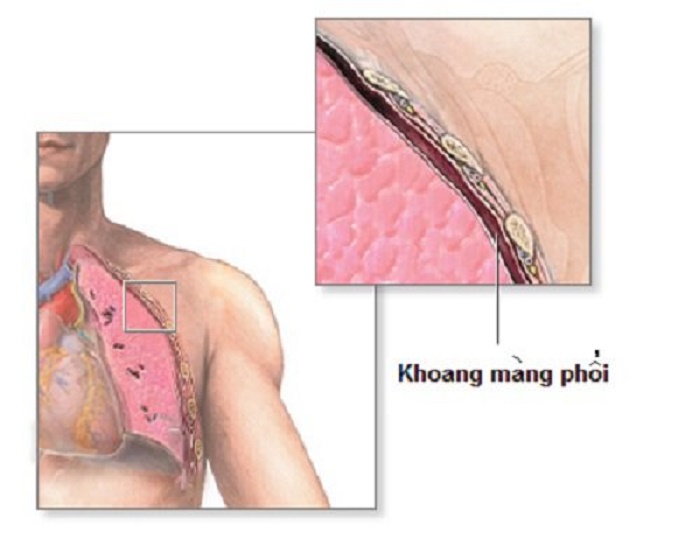 Hình ảnh giải phẫu khoang màng phổi