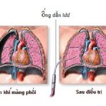 Đa số các trường hợp tràn khí màng phổi vừa và nhẹ đều có tiên lượng tốt, điều trị khỏi và không để lại di chứng