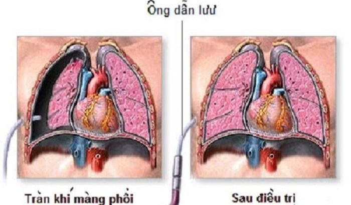 Bệnh Tràn khí màng phổi có nguy hiểm không? Tiên lượng sau điều trị