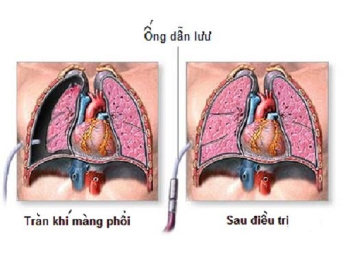 Đa số các trường hợp tràn khí màng phổi vừa và nhẹ đều có tiên lượng tốt, điều trị khỏi và không để lại di chứng
