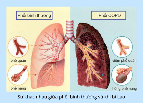 Sự khác nhau giữa phổi bình thường và khi bị Lao