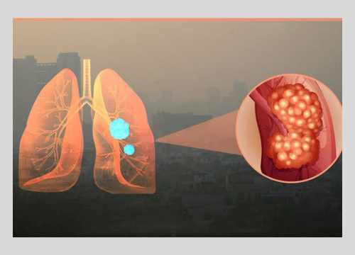 Hậu quả của ô nhiễm môi trường đến đường hô hấp