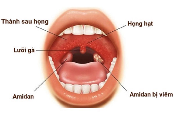 Bệnh viêm họng hạt