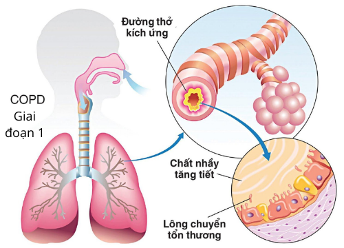 Giai đoạn 1 tắc nghẽn phổi mãn tính sống được bao lâu