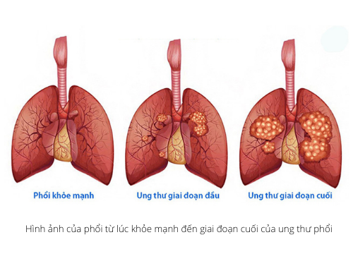 Hình ảnh của phổi từ lúc khỏe mạnh đến giai đoạn cuối của ung thư phổi