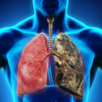 Ung thư phổi giai đoạn cuối sống được bao lâu? Lưu ý?