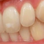 Sâu răng nhẹ: Nguyên nhân và cách điều trị