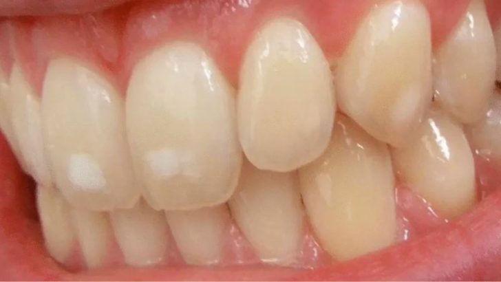 Sâu răng nhẹ: Nguyên nhân và cách điều trị
