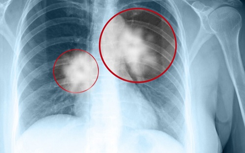 Các bệnh ý liên quan đến vết mờ tại phổi