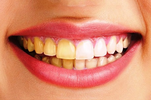 Hút thuốc lá dễ bị ố vàng trên răng