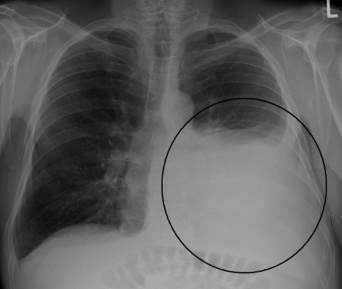 Bệnh tràn dịch màn phổi trên ảnh chụp X-quang