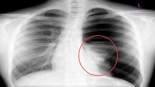 Ảnh X-quang tràn dịch màn phổi
