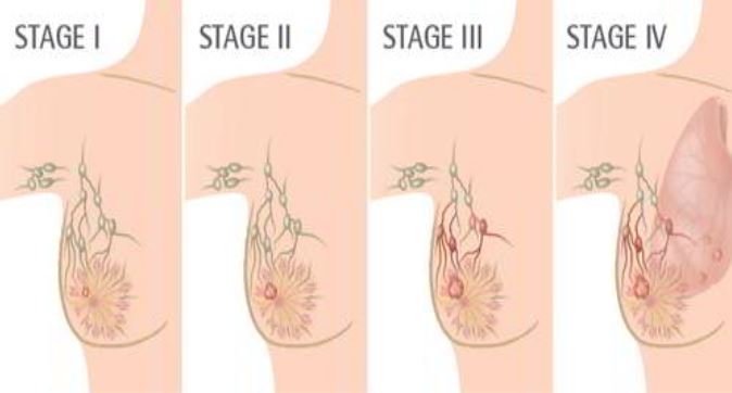 Các giai đoạn của ung thư vú