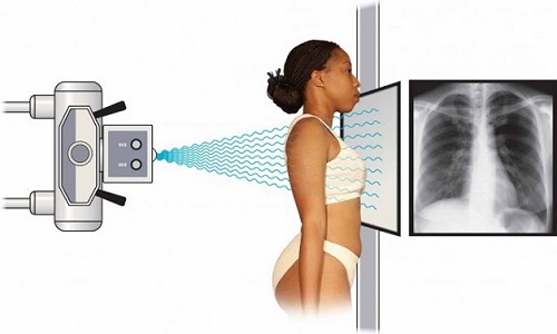 Cách người bệnh chụp X-quang phổi