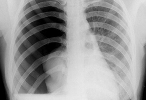 Ảnh chụp X-quang của bệnh tràn khí mà phổi