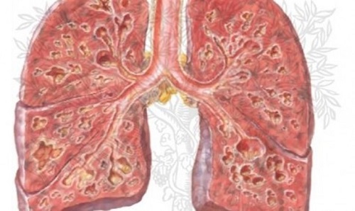 Di chứng xơ phổi một trong những di chứng nguy hiểm của lao phổi
