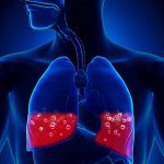 Phù phổi cấp có thể ảnh hưởng đến tính mạng