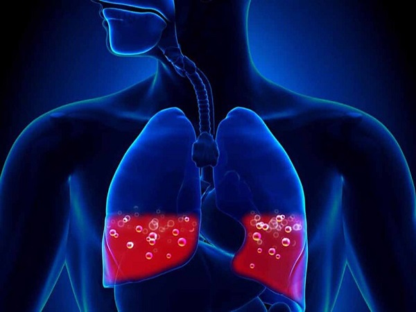 Phù phổi cấp có thể ảnh hưởng đến tính mạng