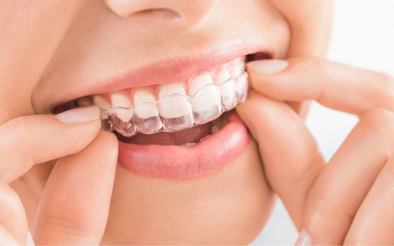 Niềng răng trong suốt là lựa chọn tối ưu cho người có răng hàm yếu