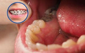 Răng hàm bị sâu có niềng được không? Nên niềng bằng phương pháp nào?
