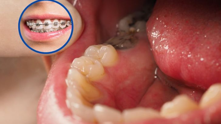 Răng hàm bị sâu có niềng được không? Nên niềng bằng phương pháp nào?
