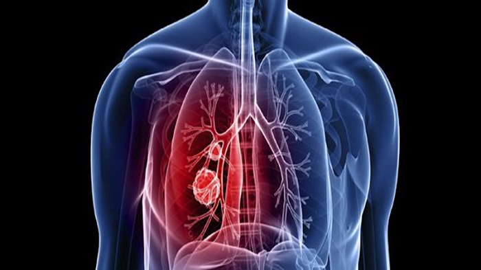 Xơ hoá phổi có thể gây nhiều biến chứng nguy hiểm như giảm nồng độ oxy máu, tăng áp động mạch phổi, suy hô hấp...