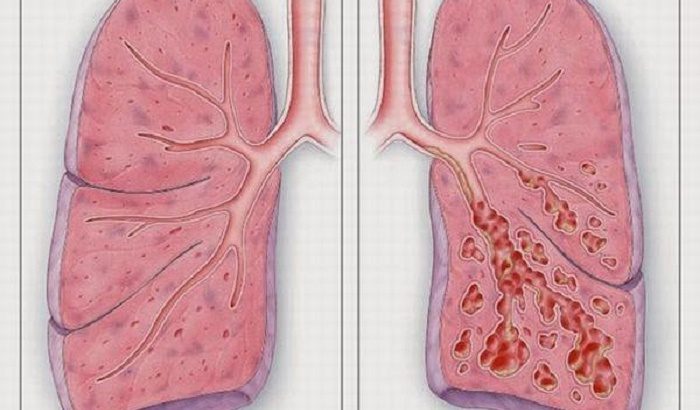 Xơ hóa phổi là bệnh gì? Nguyên nhân và Hướng điều trị