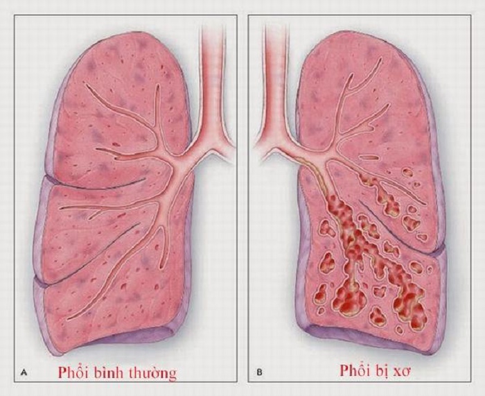 Xơ hoá phổi là tình trạng mô phổi bị tổn thương, xơ cứng và mất độ đàn hồi