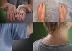 ƯU VÀ NHƯỢC ĐIỂM THUỐC UỐNG TRỊ MỒ HÔI TAY CHÂN