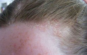 Cách trị viêm da đầu tại nhà an toàn hiệu quả