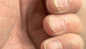 Móng tay bị sần sùi thiếu chất gì? Cần làm gì để khắc phục