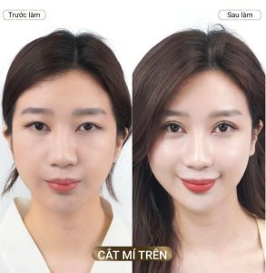 5 lưu ý khi cắt mí – Bác sĩ Henry Thanh Sơn giải đáp