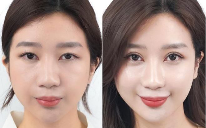 5 lưu ý khi cắt mí – Bác sĩ Henry Thanh Sơn giải đáp